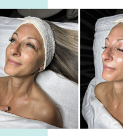 Chicago Facial
