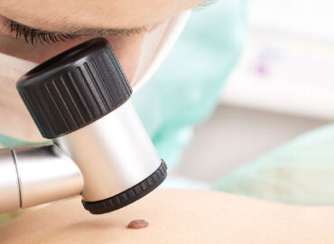 Mole Check Clinic in Northcote