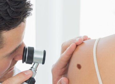 Mole Check Clinic in Northcote