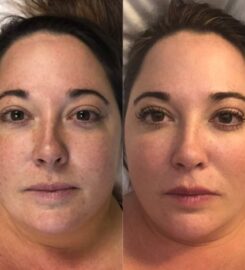 Laserbody MD