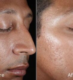 Laserbody MD