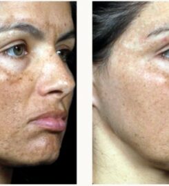 Laserbody MD