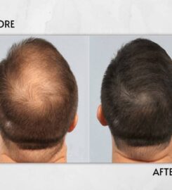 Laserbody MD