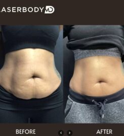 Laserbody MD