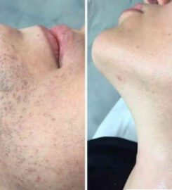 Laserbody MD