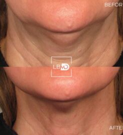 Laserbody MD