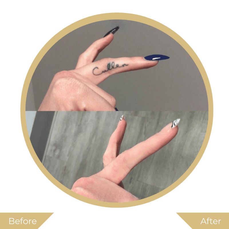 Laser Tattoo Removal