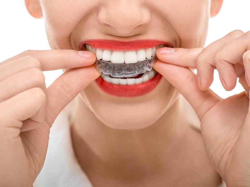 Poole Teeth Straightening