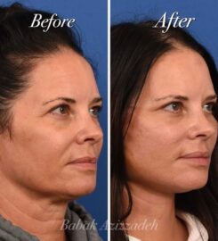 Center For Advanced Facial Plastic Surgery