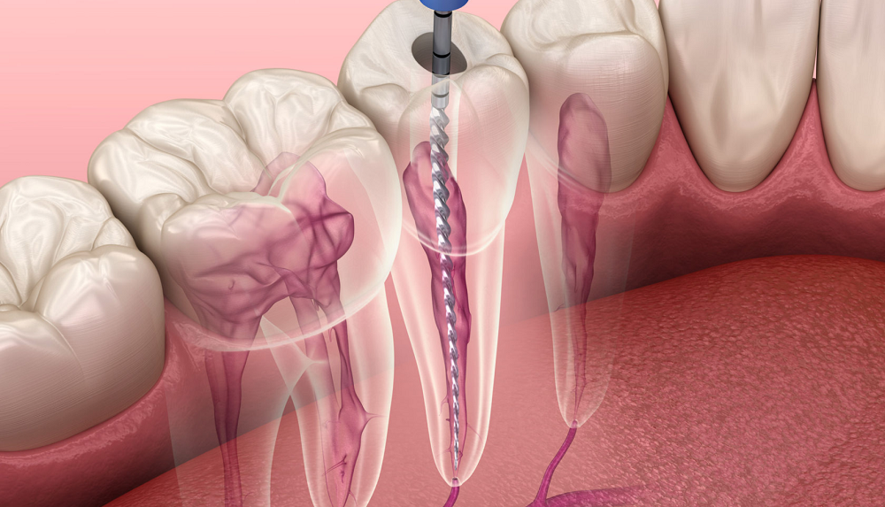 Advanced Root Canal Care at Agrawal Dental Clinic